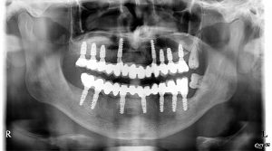 metamorfoza-3-pantomogram
